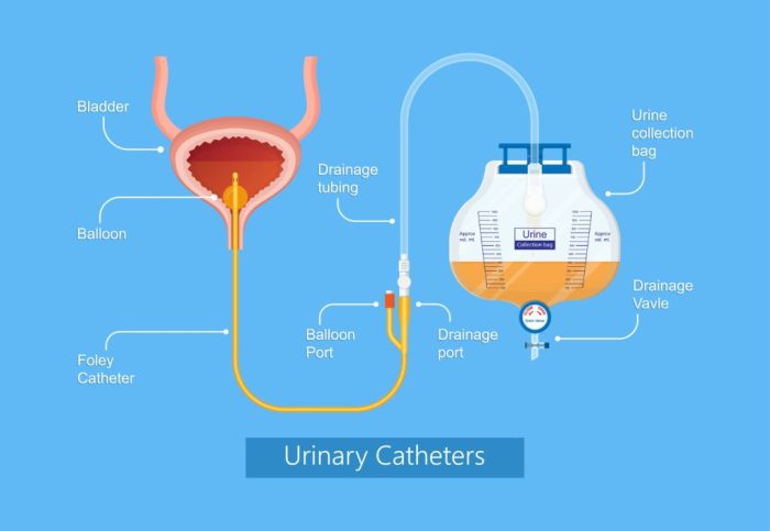 Foley catheter care nurse teaching