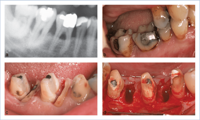 Which procedure removes a root from a multi-rooted tooth