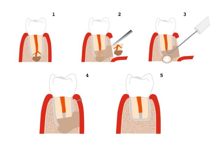 Which procedure removes a root from a multi-rooted tooth