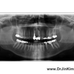 Resection root