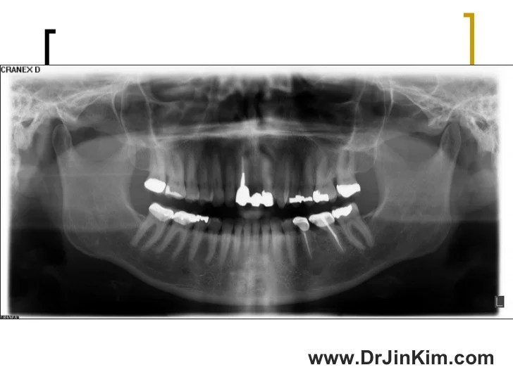 Resection root